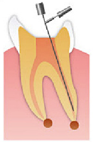 歯の神経を取った後にねの長さを測る。