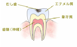 C1エナメル質の虫歯