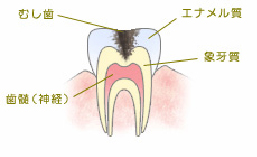 C2象牙質の虫歯