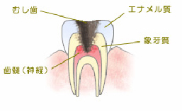 C3神経まで達した虫歯