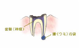 C4歯根まで達した虫歯