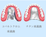 金属床義歯