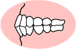 上下顎前突