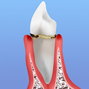 歯周病の進行